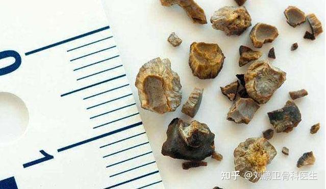 肾结石患者如何补钙
