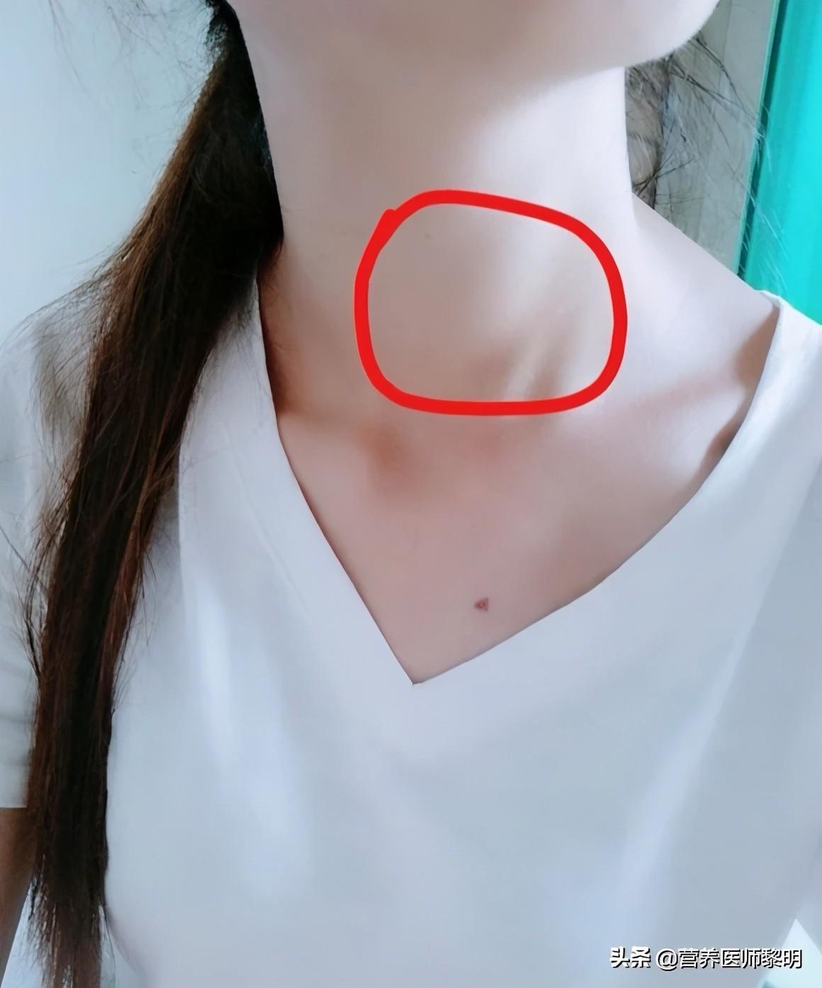 补硒后轻微甲亢好了