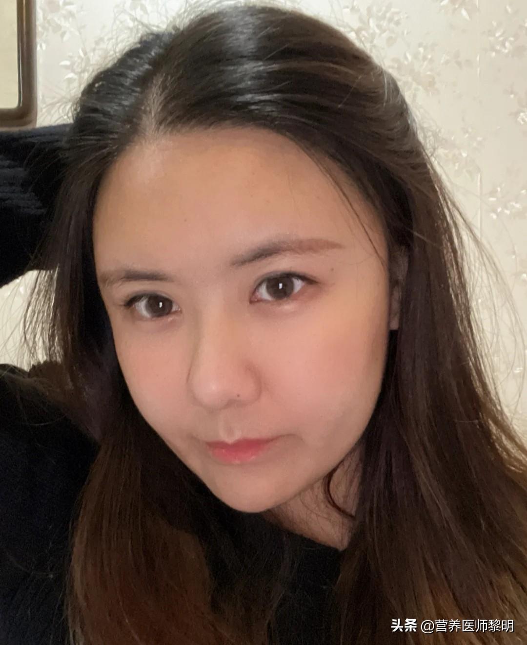 补硒后轻微甲亢好了