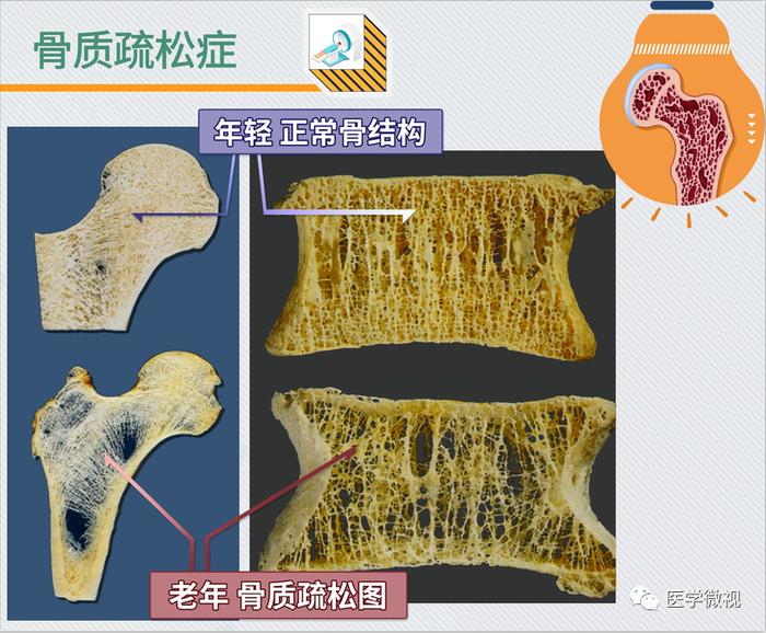 骨质疏松需要补钙吗