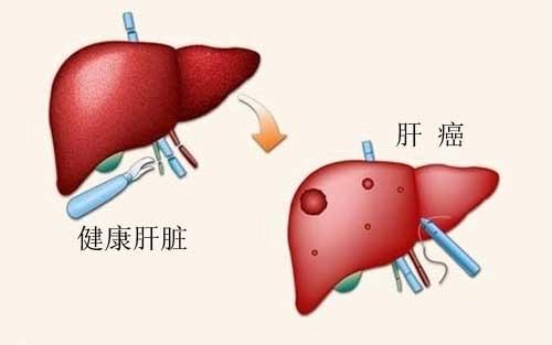 肝癌可以长期补硒吗