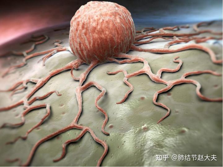 补硒能治疗肺部结节