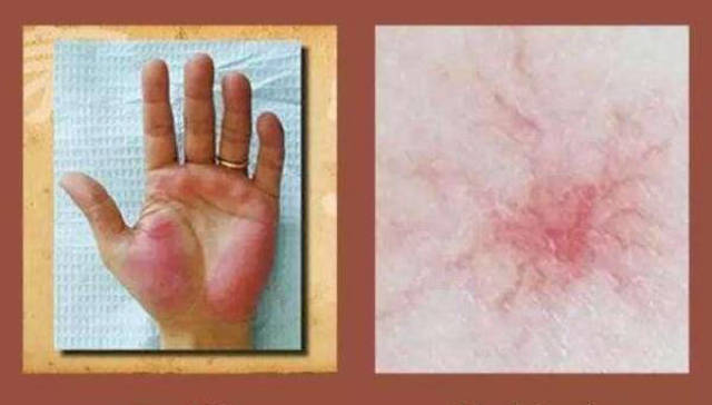 丙肝患者需要补硒吗