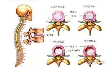 腰椎间盘突出能补钙吗