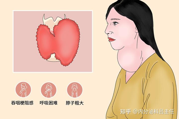 肺部结节补硒能消除