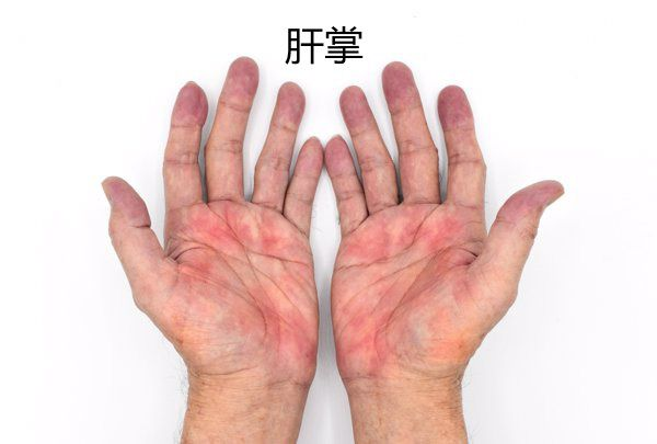 肝硬化是否需要补硒