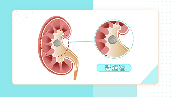 肾结石患者怎么补钙