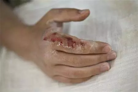 补硒能治疗白癜风吗