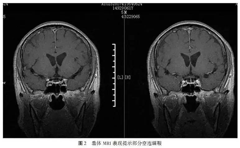 盐胶囊补钠口服用量