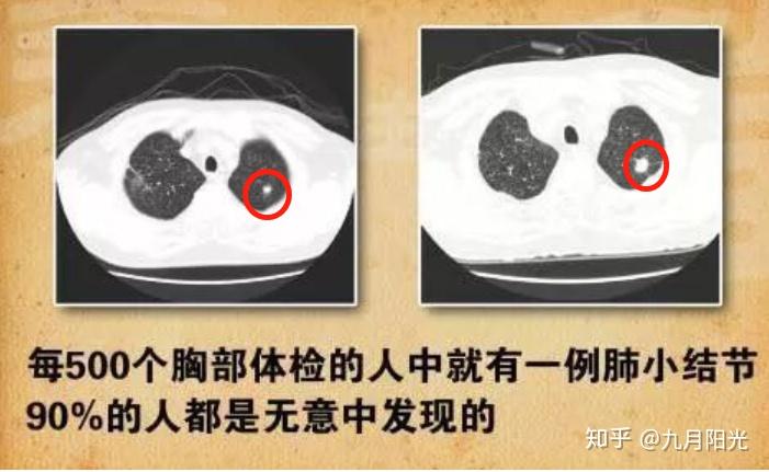 补硒可以治好肺结节