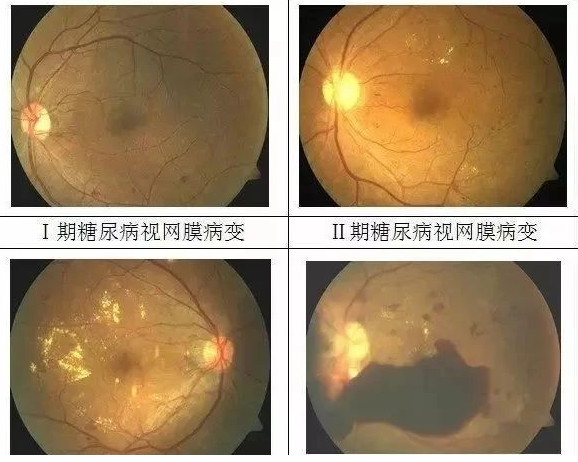 糖尿病需要补硒多久