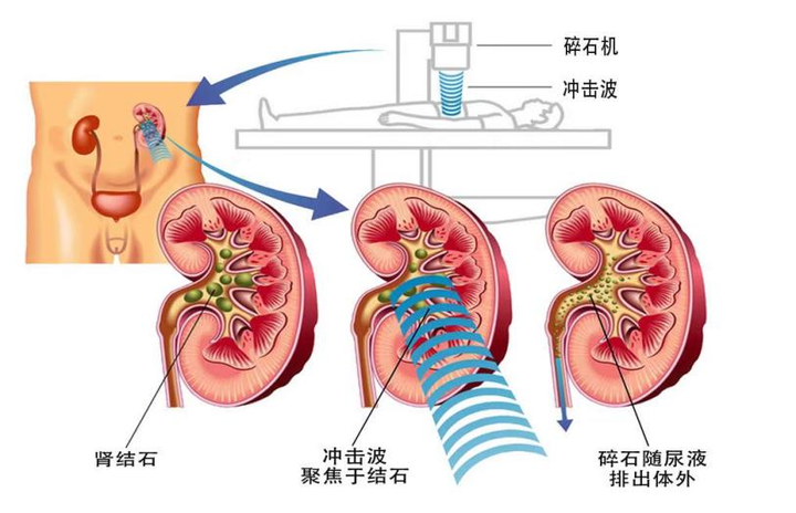肾结石患者如何补钙