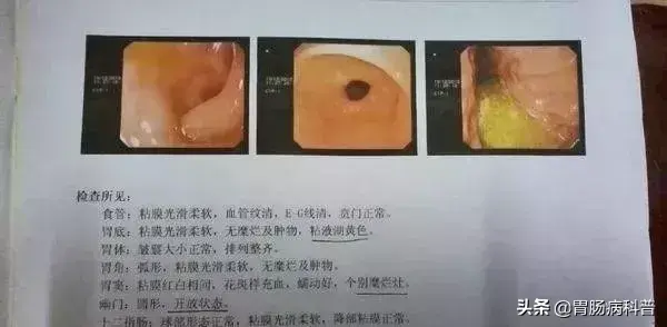 胆汁返流可以补硒吗