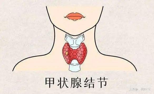 补硒预防甲状腺癌吗