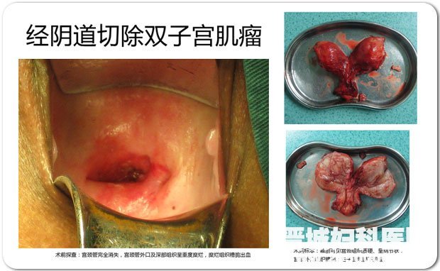 治疗宫颈炎补硒用量