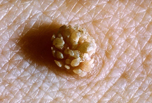 治疗宫颈炎补硒用量