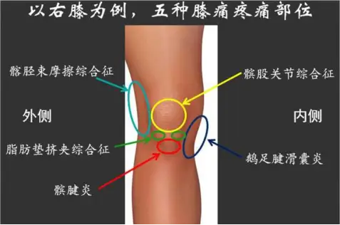 关节炎需要补钙吗