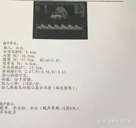孕期几个月开始补铁