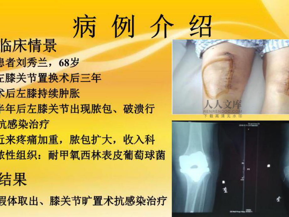 大骨节病补硒可以吗