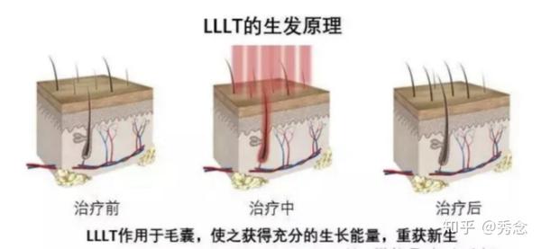 红斑狼疮能不能补硒