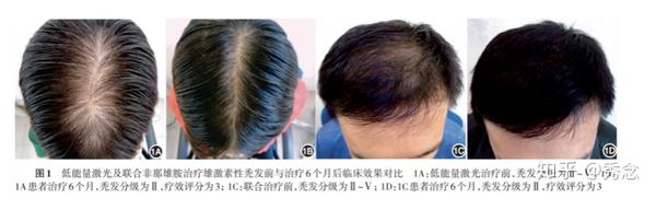 红斑狼疮能不能补硒