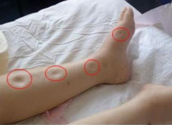 糖尿病患者如何补硒
