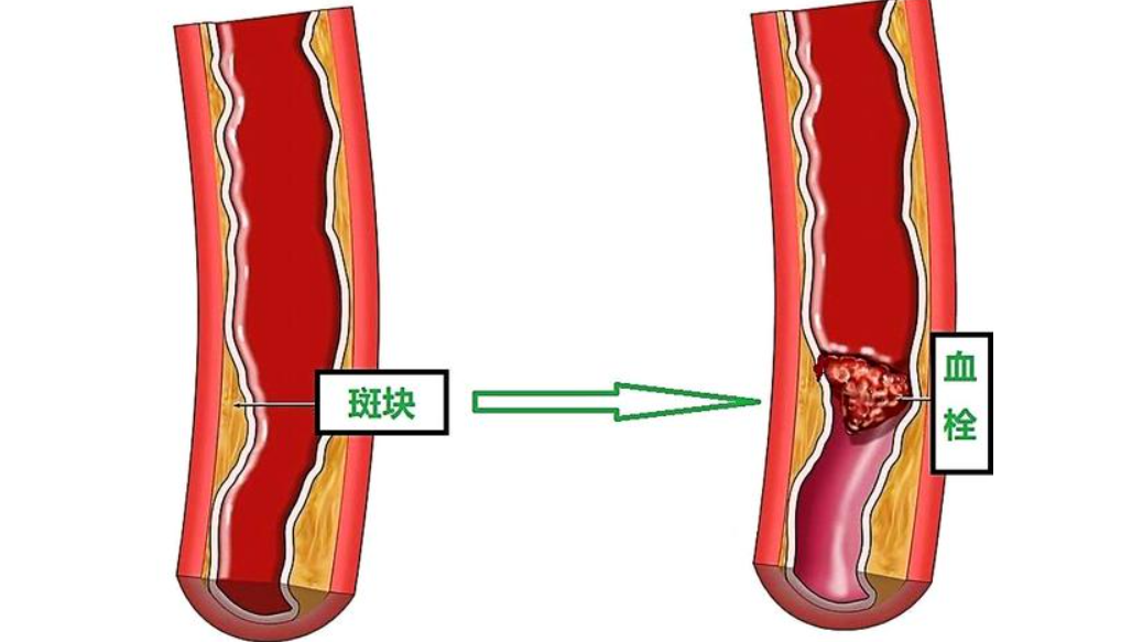 补硒可以防白血病麽