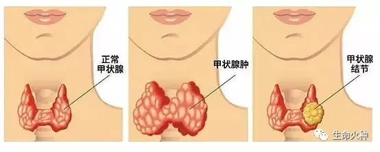 甲减单独补硒可以吗
