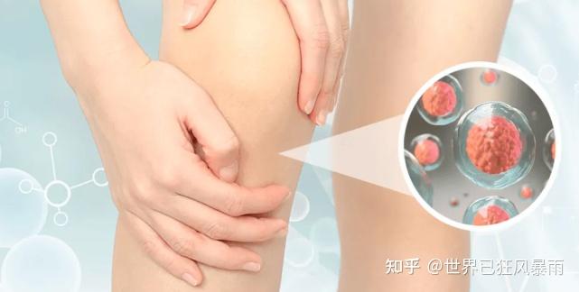 补硒对关节炎的好处
