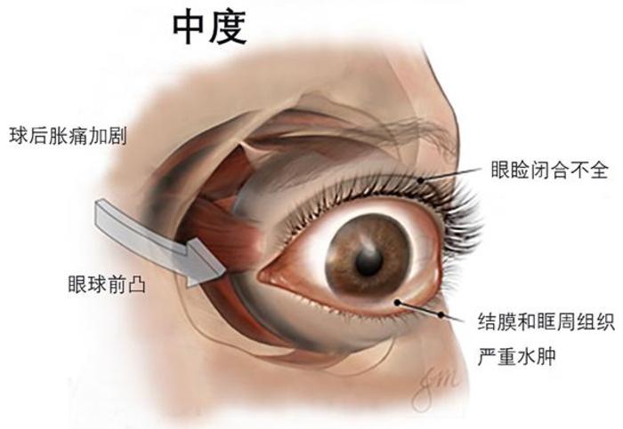 甲亢突眼补硒有用吗