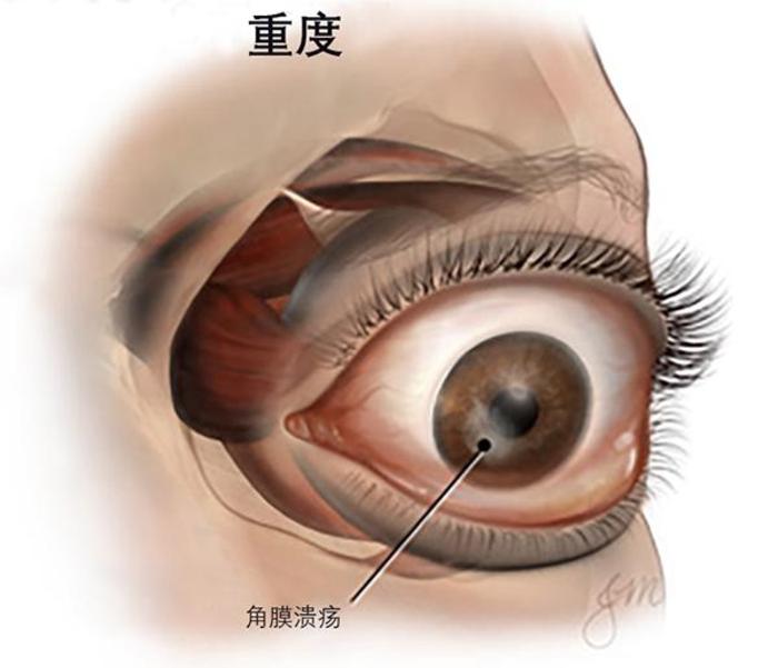 甲亢突眼补硒有用吗