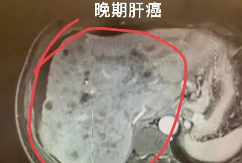 抗乙肝病毒补硒治愈