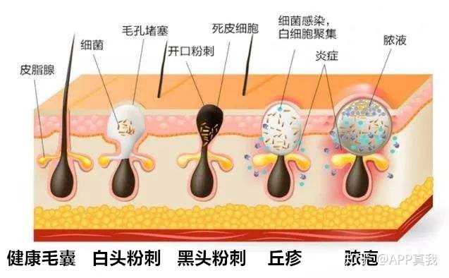 补硒会不会长痘印呢