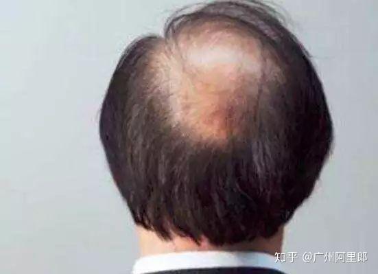 正常补硒会掉头发吗