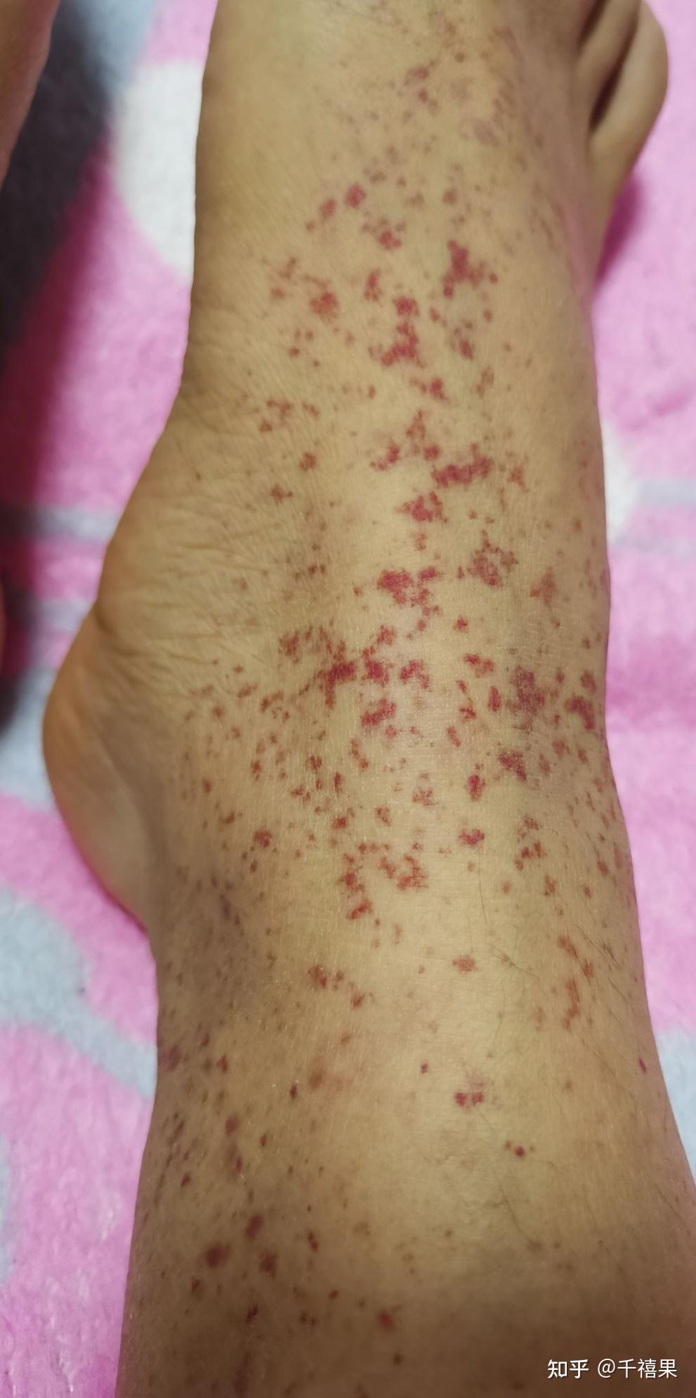 过敏性紫癜能补硒吗