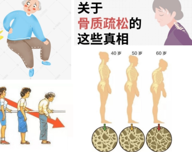 骨质疏松补钙