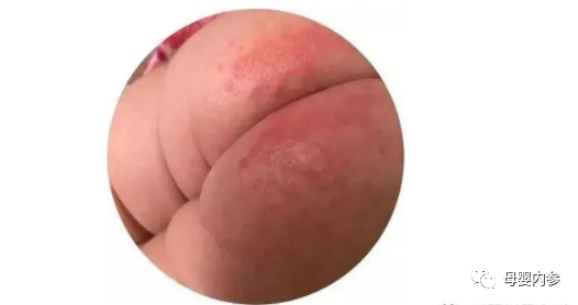 感冒期间可以补锌吗