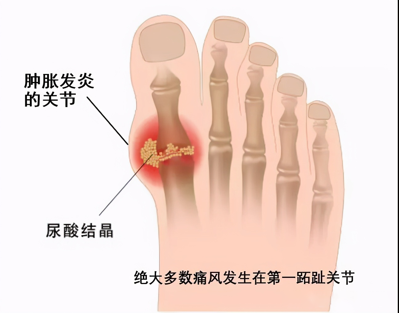 血钠低怎么补