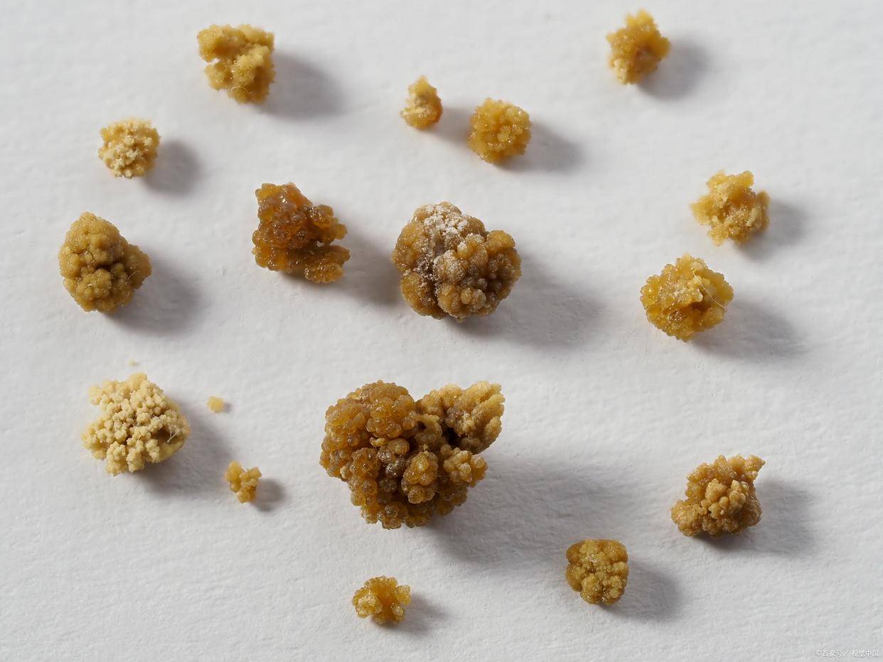 肾结石补钙用哪种钙片