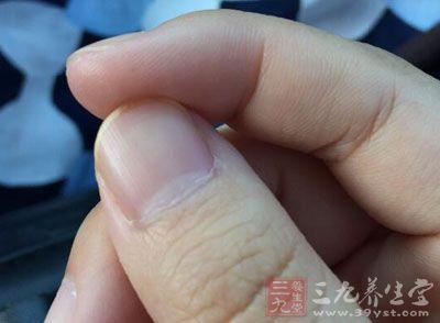 缺锌白斑补锌会消失吗