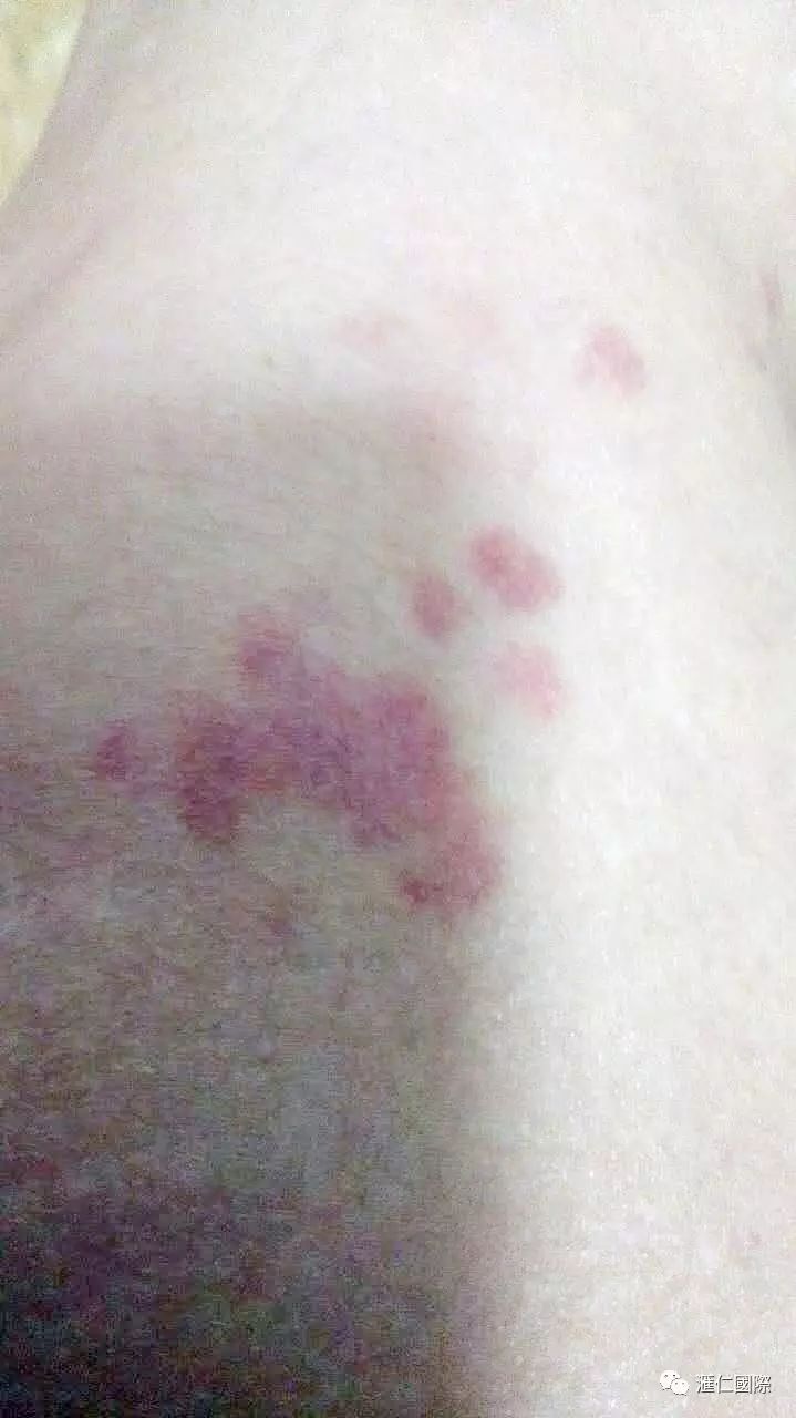 直肠癌能吃硒维康吗