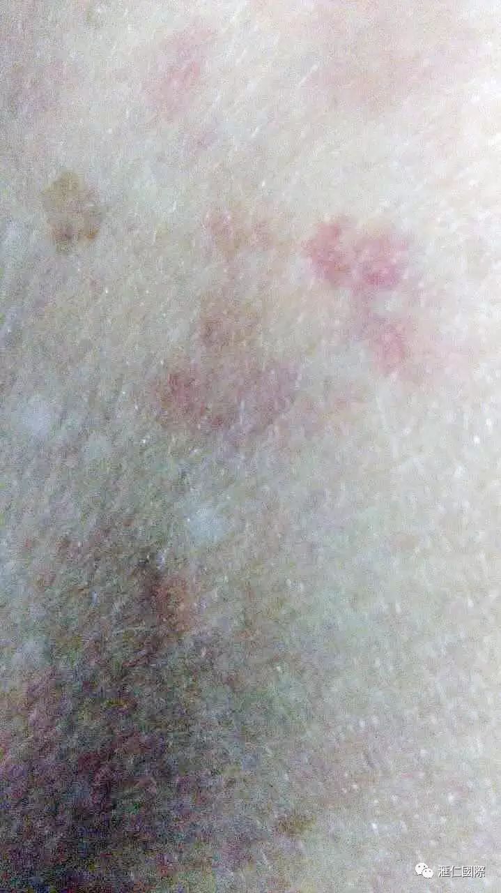 直肠癌能吃硒维康吗