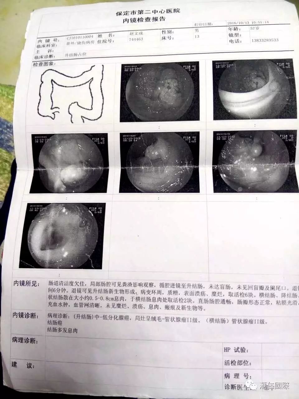 直肠癌能吃硒维康吗