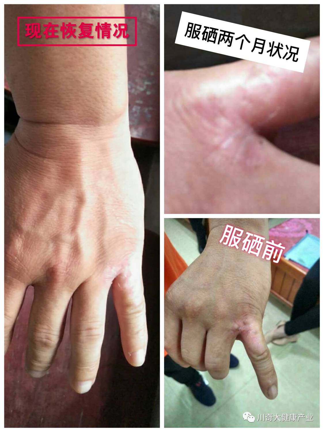 直肠癌能吃硒维康吗