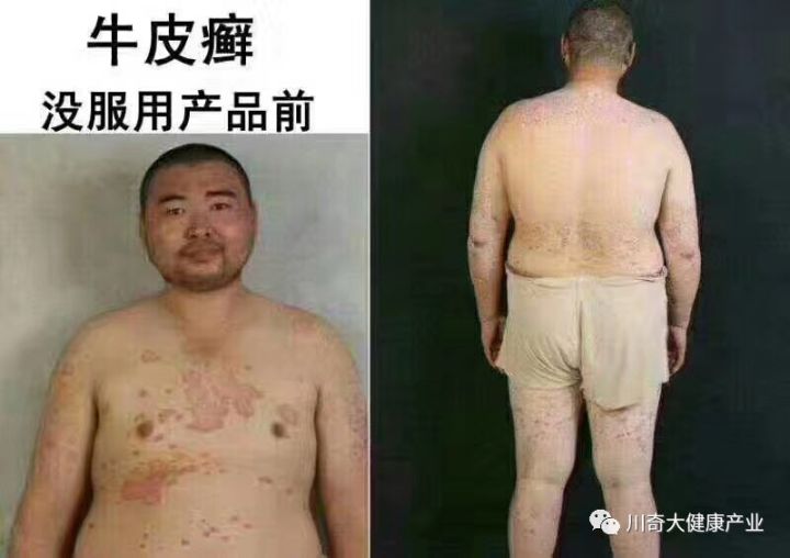 直肠癌能吃硒维康吗
