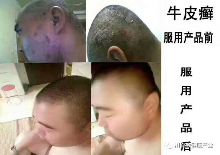 直肠癌能吃硒维康吗