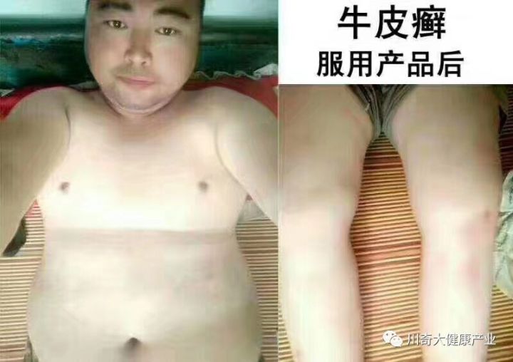 直肠癌能吃硒维康吗