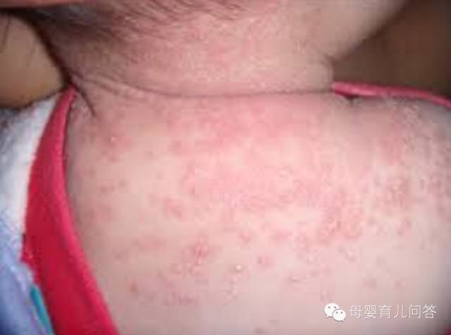 宝宝吃锌硒宝起疹子