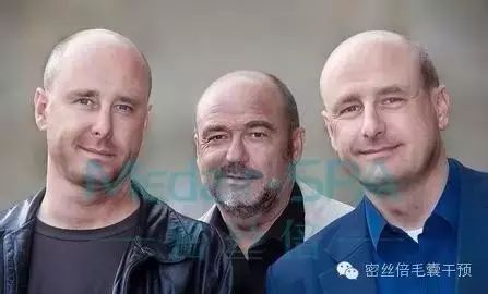 脱发缺什么微量元素