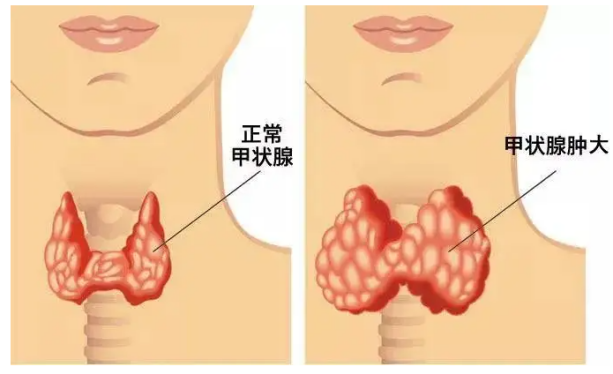 为什么甲状腺炎要补硒